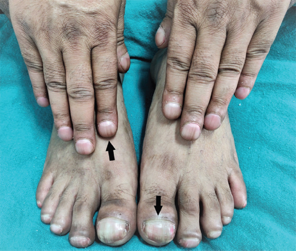 Pan digital clubbing (arrows) as a manifestation thyroid acropachy.